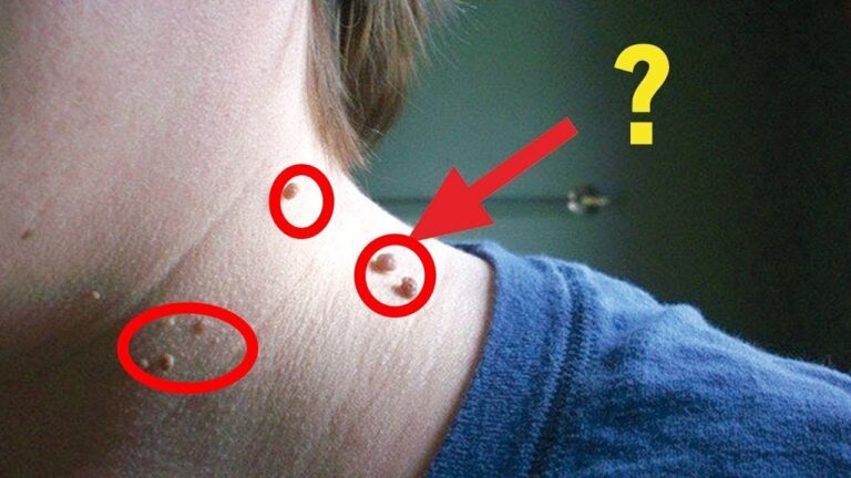 Entferne Hautanhängsel in 3 einfachen Schritten – so schnell wirst du erstaunt sein!