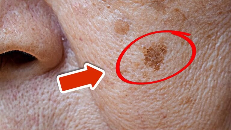 Altersflecken über Nacht loswerden – 1 geheimes Mittel, das funktioniert!