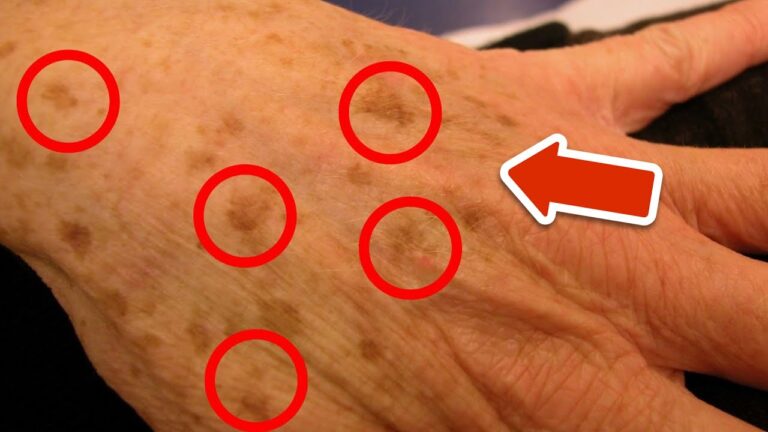 5 effektive Vitamine gegen Altersflecken – So wirst du sie los!