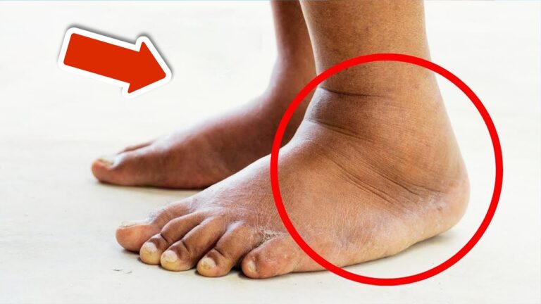 5 Lebensmittel, die Schwellungen in Beinen und Füßen sofort lindern!