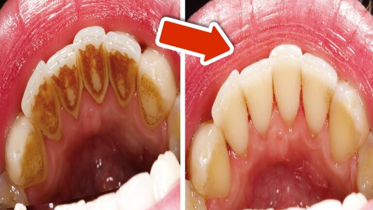 Zahnbelag richtig entfernen: 5 einfache Methoden ohne Zahnarztbesuch!