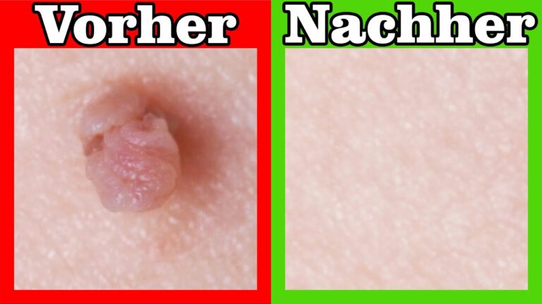 Schnell 5 Hausmittel gegen Hautanhängsel entdecken – So wirst du sie los!