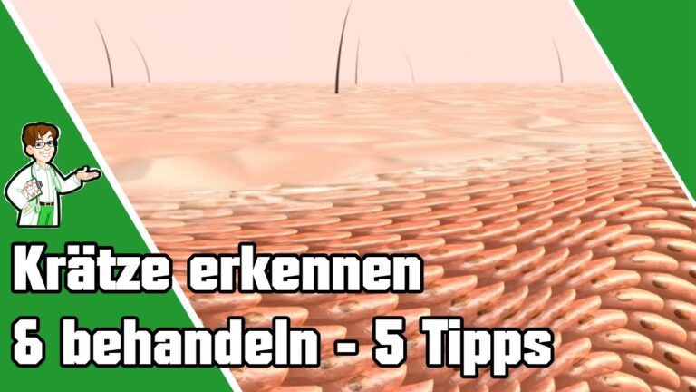 5 Tipps zur schnellen Erkennung und Behandlung von Krätze für sofortige Hilfe
