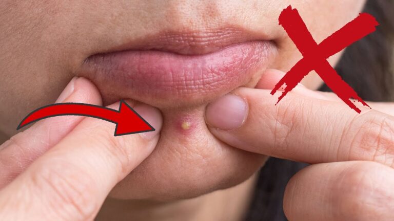 6 Orte, an denen du niemals einen Pickel ausdrücken solltest!
