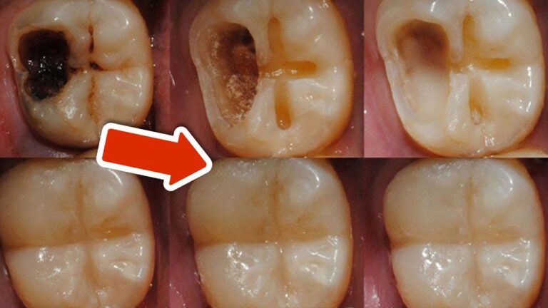 5 einfache Geheimtipps gegen Zahnverfall, die du sofort umsetzen kannst!